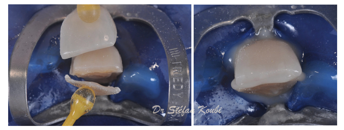 veneers and crowns /Dr Stefan Koubi